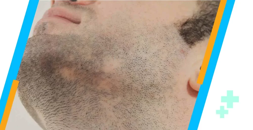 Beard Transplant For Men