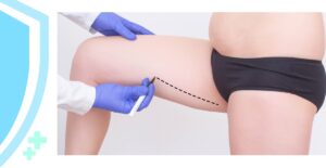 Buttock Lift