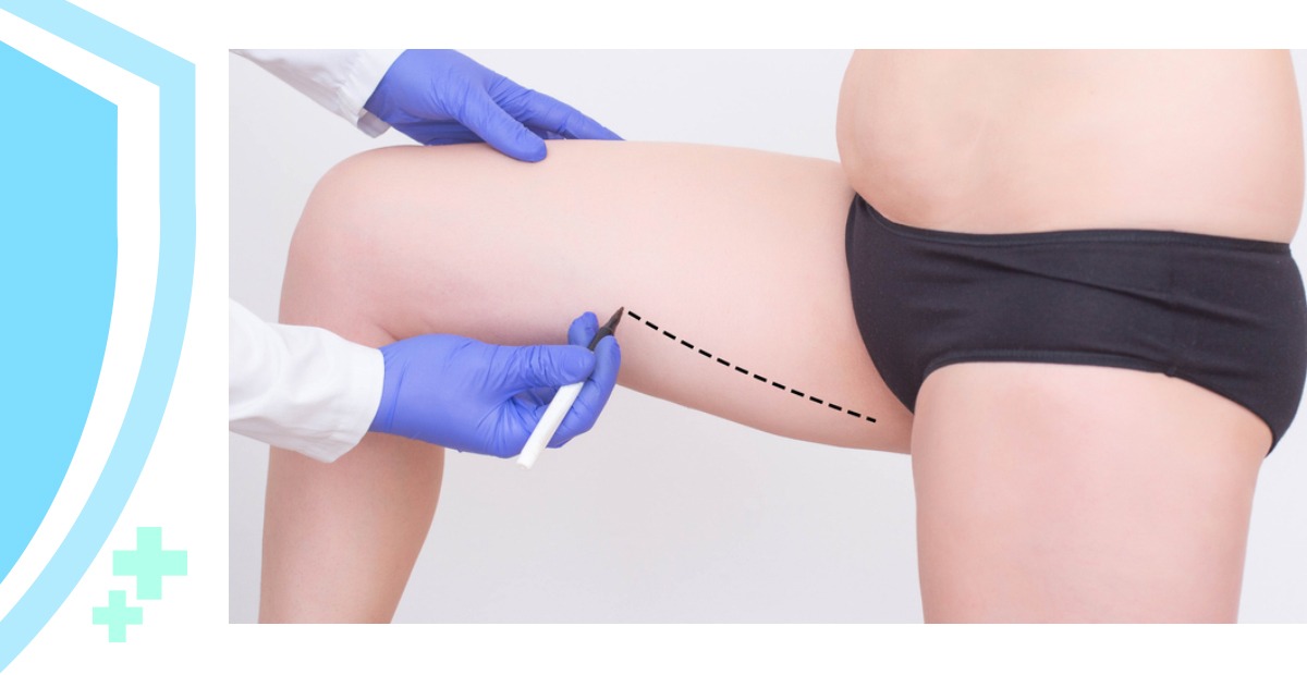 Buttock Lift