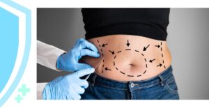 Tummy Tuck